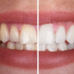 Diş Beyazlatma (1)