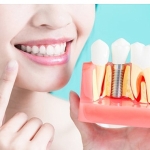 dis-implantlari-hakkinda-bilmeniz-gereken-9-bilgi.jpg