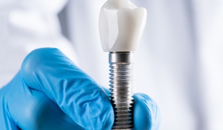 İmplant Tedavisi ile Kalıcı ve Estetik Çözümler