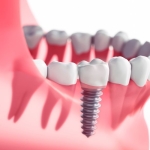 konya implant (2)