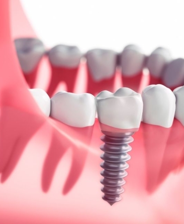 konya implant (2)